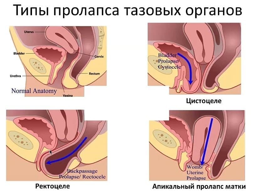 Опущение матки - симптомы, лечение опущения матки в Москве, Клинический Госпиталь на Яузе